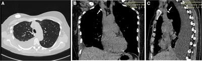 Case report: Successful multimodal assessment and management of chemothorax